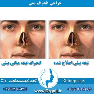 اقدامات لازم در هفته اول بعد از عمل جراحی بینی