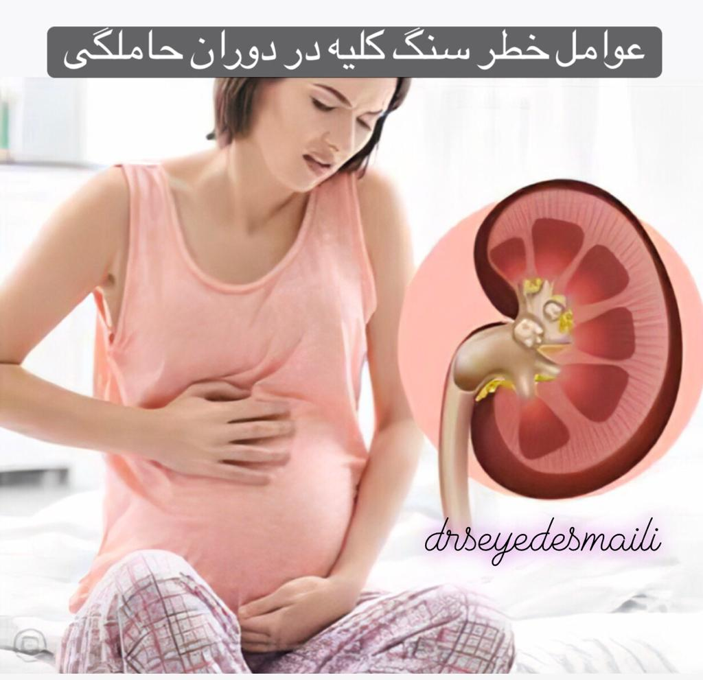 سنگ کلیه در دوران بارداری