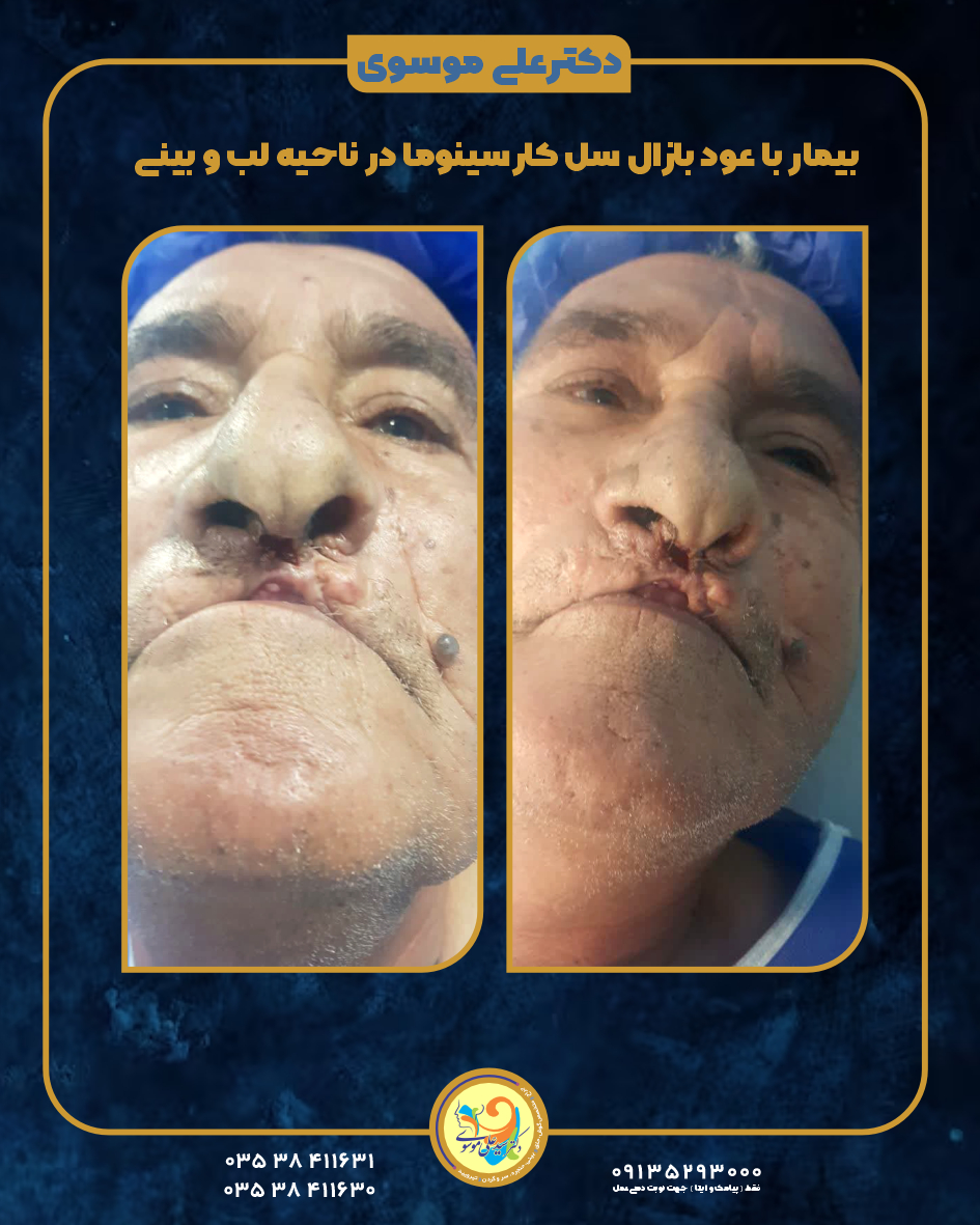 بازال سل کارسینوما در ناحیه لب و بینی