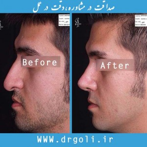 اعتماد به نفس با جراحی زیبایی بینی