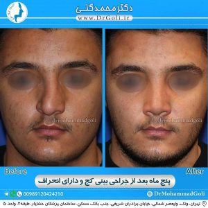 جراحی بینی کج