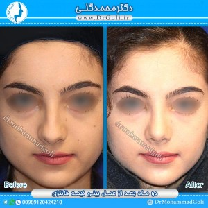 اقدامات قبل از جراحی بینی فانتزی