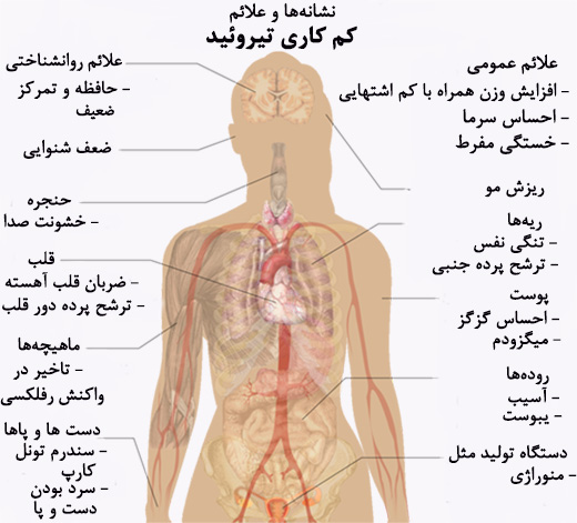 کم کاری غده تیروئید