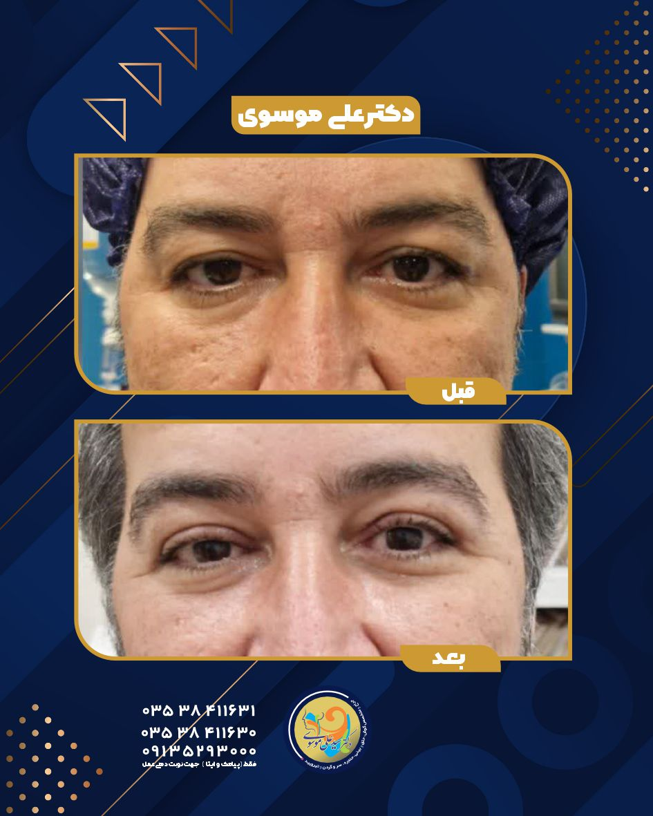 بلفاروپلاستی (جراحی زیبایی پلک)