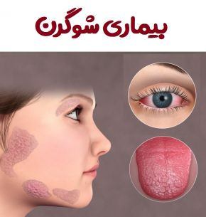 تغذیه در بیماری سندرم شوگرن و بیماری اسکلرودرمی
