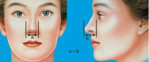 یکی شدن سوراخ های بینی بعد از عمل زیبایی