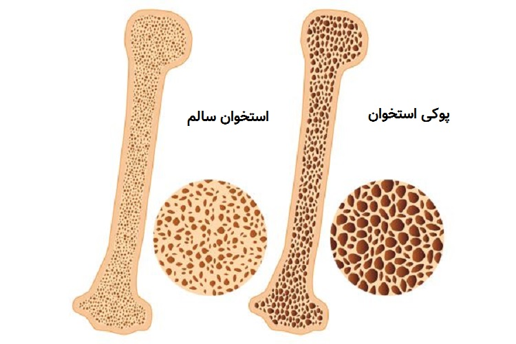 ویتامین D و کلسیم؛ دو رکن اصلی پیشگیری و مدیریت پوکی استخوان