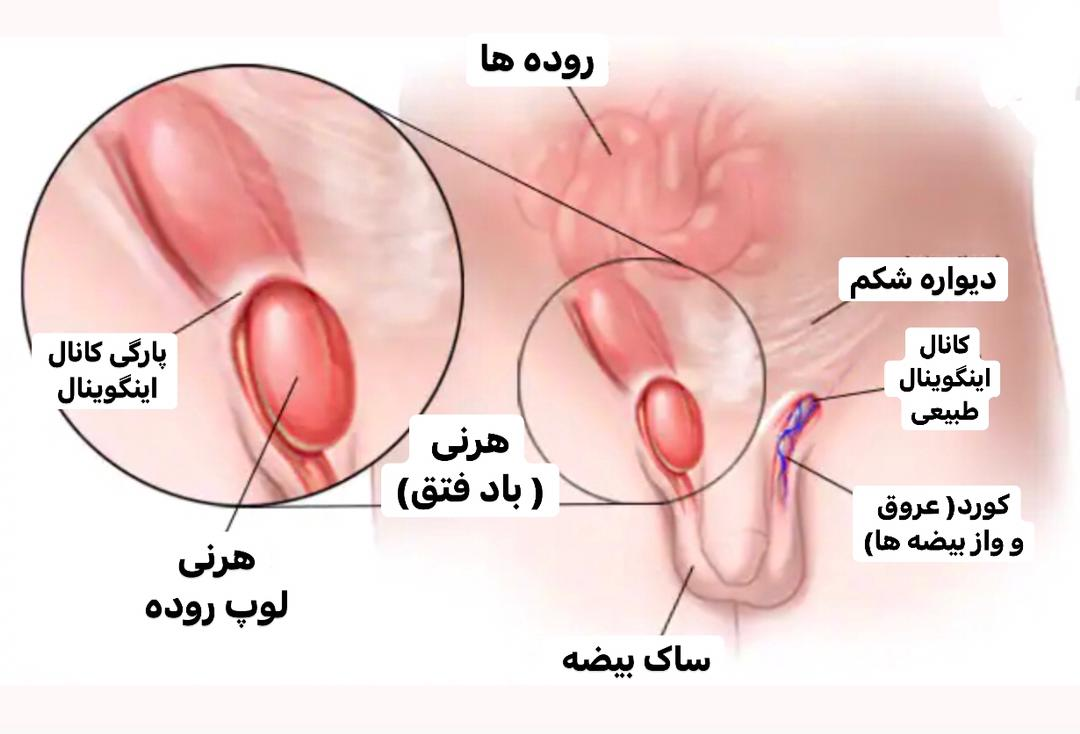 باد فتق