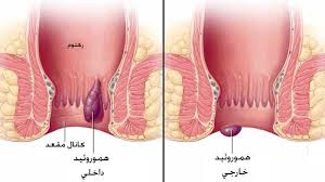هموروئید چیست