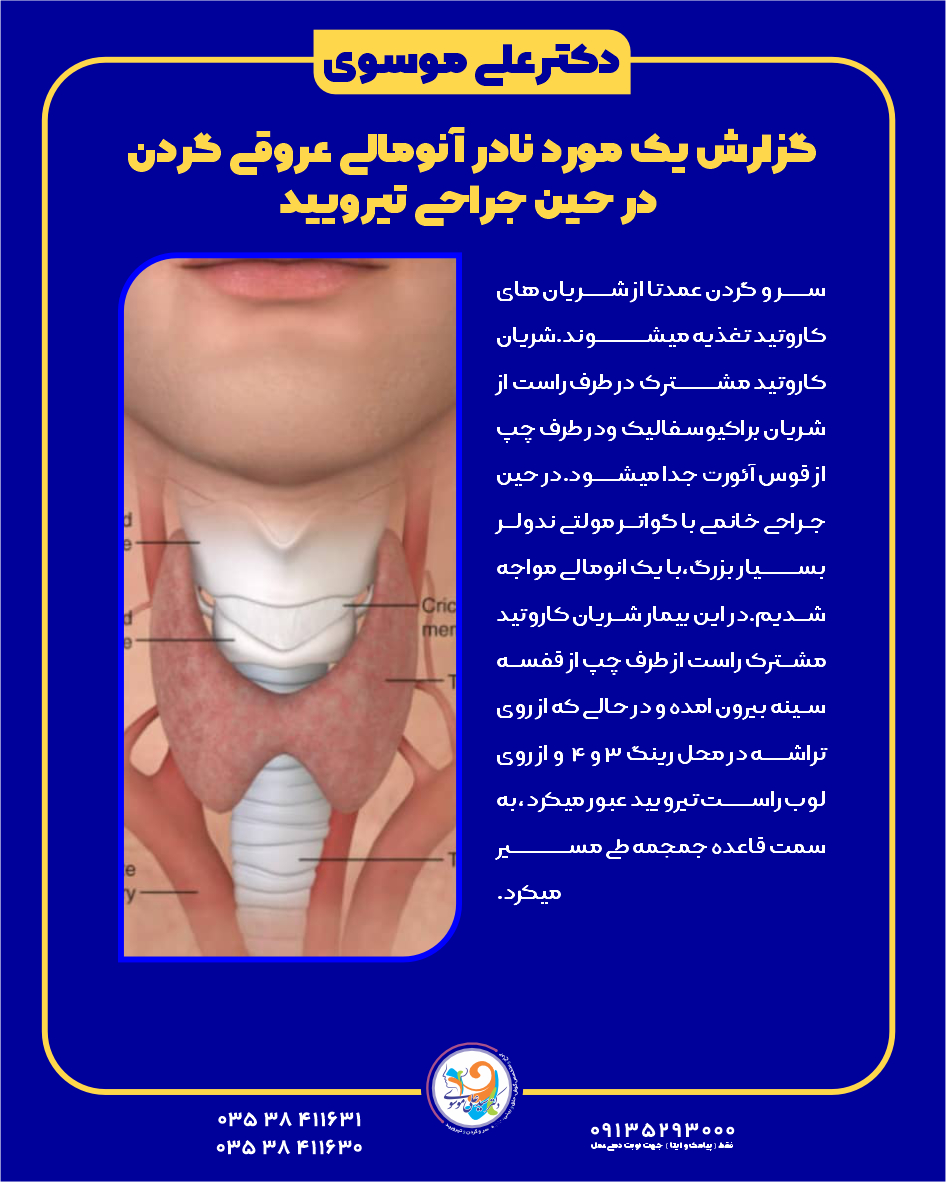 گزارش یک مورد نادر آنومالی عروقی گردن  در حین جراحی تیرویید