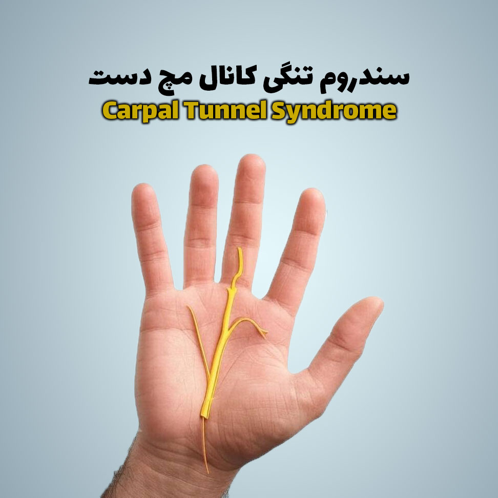سندروم تنگی کانال مچ دست (Carpal Tunnel Syndrome)