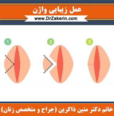 همه چیز درباره لابیاپلاستی و هزینه لابیاپلاستی (عمل زیبایی واژن)
