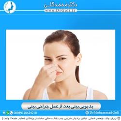 بدبویی بینی بعد از عمل جراحی بینی