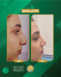 جراحی زیبایی بینی چیست و برای چه افرادی مناسب است؟