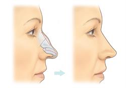 انواع جراحی بینی