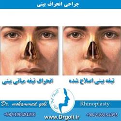 اقدامات لازم در هفته اول بعد از عمل جراحی بینی