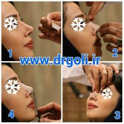 چسب زدن بعد از جراحی بینی