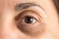 علت تیرگی زیر چشم و چگونگی بهبود آن