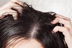 دلایل ایجاد شوره بر روی سر چیست؟