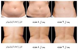آیا من گزینه مناسبی برای درمان  کرایولیپولیز هستم ؟