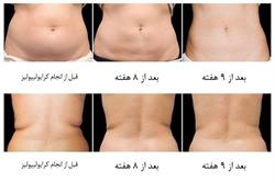 آیا من گزینه مناسبی برای درمان  کرایولیپولیز هستم ؟