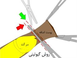 همه چیز در مورد ختنه