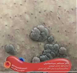 زگیل تناسلی در مردان و زنان (HPV) | بهترین روش درمان و پیشگیری از زگیل تناسلی