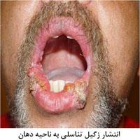 زگیل تناسلی