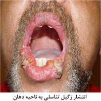 زگیل تناسلی