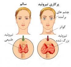 پرکاری تیروئید و درمان غذایی