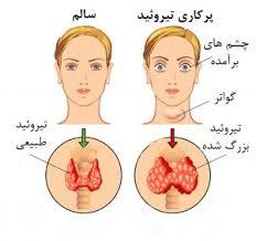 پرکاری تیروئید و درمان غذایی