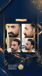 عمل زیبایی بینی در یزد؛ قبل و 3 ماه بعد از رینوپلاستی یک آقای جوان