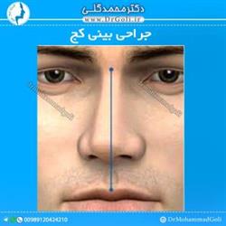جراحی بینی کج