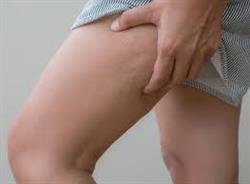 تفاوت چاقی و سلولیت