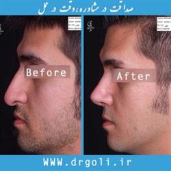 اعتماد به نفس با جراحی زیبایی بینی