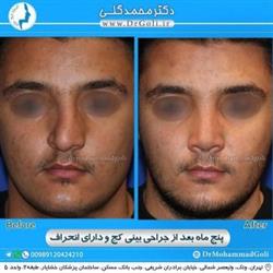 جراحی بینی کج