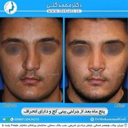 جراحی بینی کج