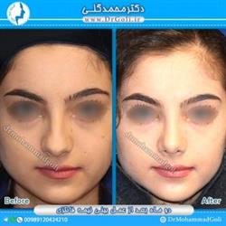 اقدامات قبل از جراحی بینی فانتزی