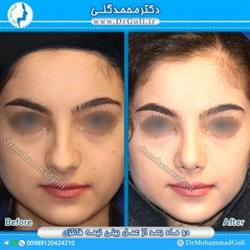 اقدامات قبل از جراحی بینی فانتزی