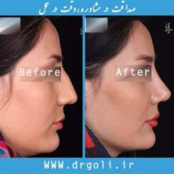 بیهوشی در جراحی بینی