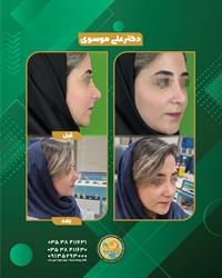 عمل زیبایی بینی در یزد؛ اصلاح همزمان تنفس و فرم بینی در یک جراحی ترمیمی