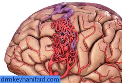 سکته مغزی ، پیشگیری، علائم، درمانها - دکتر مجید کیهانی فرد