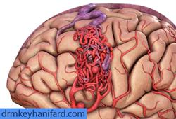 سکته مغزی ، پیشگیری، علائم، درمانها - دکتر مجید کیهانی فرد