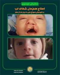 اصلاح همزمان شکاف لب و دفورمیتی سوراخ بینی ده روز بعد از عمل