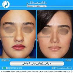 سن مناسب برای جراحی زیبایی بینی