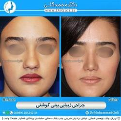 سن مناسب برای جراحی زیبایی بینی