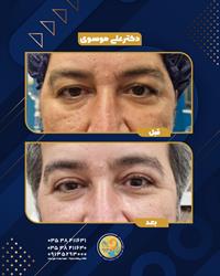 بلفاروپلاستی (جراحی زیبایی پلک)