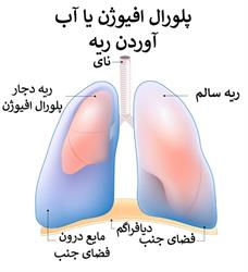 پلورال افیوژن یا آب آوردن ریه