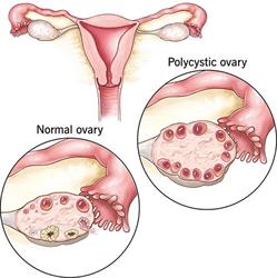 نقش تغذیه در مدیریت سندرم تخمدان پلی کیستیک (PCOS)