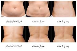 پکیج کرایولیپولیز در مرکز آرمیتا کلینیک